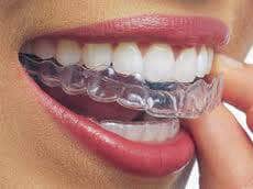 ULTRA THIN HARD ACRYLIC SINGLE 1MM SLIM FIT CUSTOM BITE GUARD